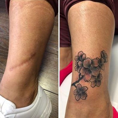 Tatuaje tapado de cicatriz con flores estilo realismo Covered scar tattoo with realism style flowers